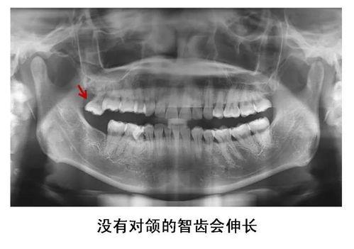 明星网红拔智齿视频播放,网友直呼太真实！