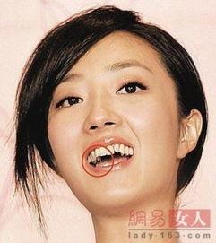 蛀牙的明星网红是谁,揭秘明星蛀牙背后的故事